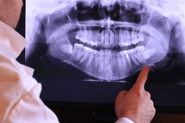 Best Emergency Wisdom Teeth Removal in Hockessin, DE