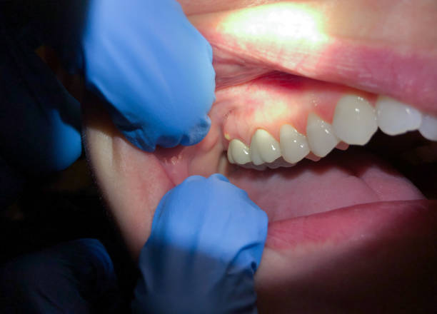 Best Emergency Tooth Extraction in Hockessin, DE